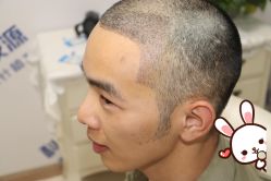 -大麦微针植发丨全国连锁