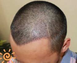 -大麦微针植发丨全国连锁