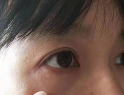 -北京美痣堂古方祛痣斑疣瘊
