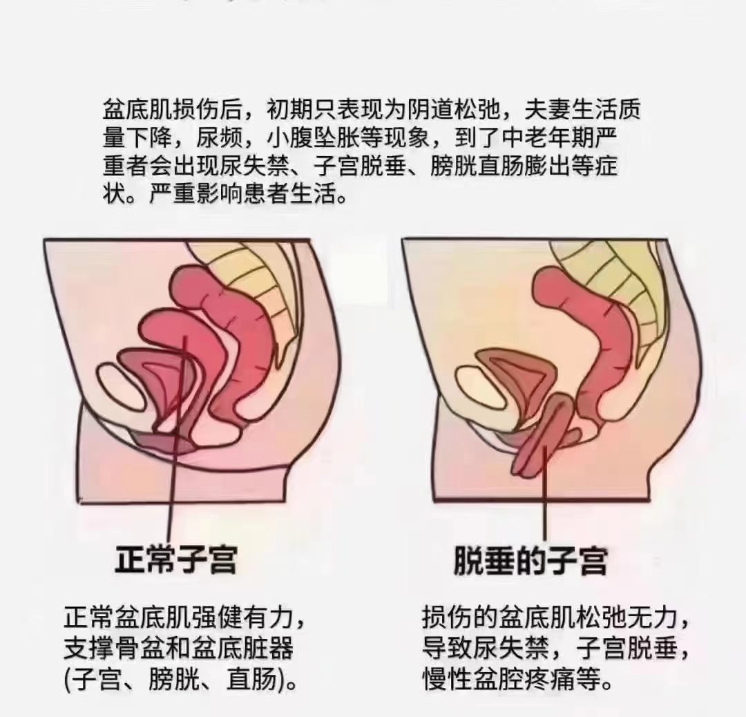 产后直肠膨出图图片