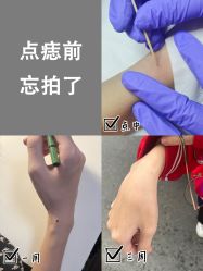 -清疣美疣·痣·斑净肤中心