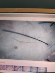 -碧莲盛·不剃发植发