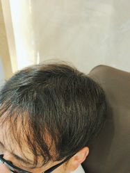 -碧莲盛·不剃发植发