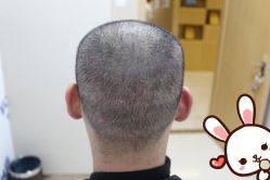 -大麦微针植发丨全国连锁