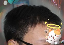 -大麦微针植发全国连锁