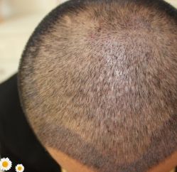 -大麦微针植发丨全国连锁