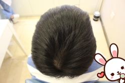 点击看大图 -大麦微针植发丨全国连锁