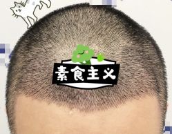 -大麦微针植发全国连锁