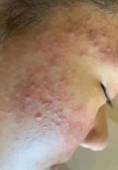 -苗方清颜专业祛痘连锁机构