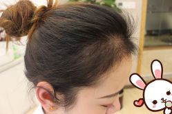 -大麦微针植发丨全国连锁