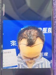 -北京雍禾植发医院