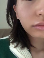 体验后-圣嘉新医疗美容医院