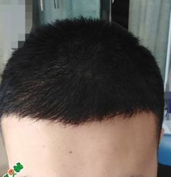 -大麦微针植发丨全国连锁
