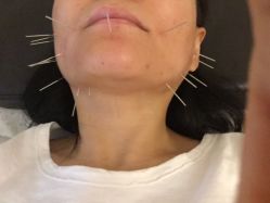 -肥三针腧穴瘦身馆