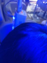 体验前-碧莲盛·不剃发植发