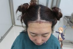 -大麦微针植发丨全国连锁