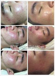 平坑效果-苗方清颜专业祛痘