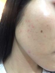 点击看大图 -清颜堂丨分子祛痘·功效美肤