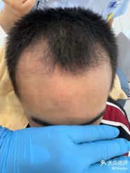 -大麦微针植发丨全国连锁