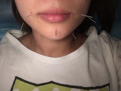 -肥三针腧穴瘦身馆