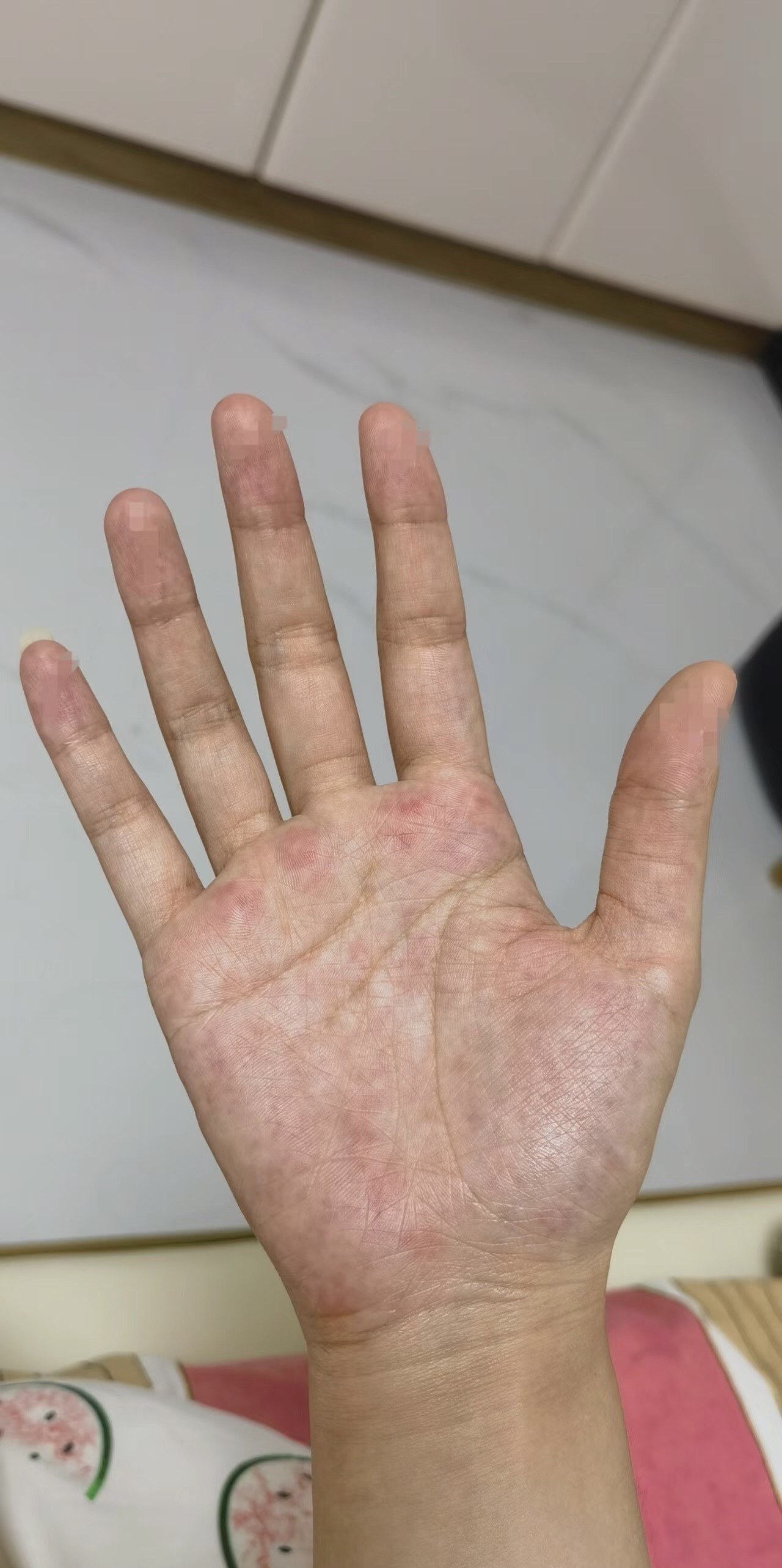 大部分人手掌花是什么原因