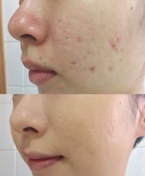 -苗方清颜痘肌研究所