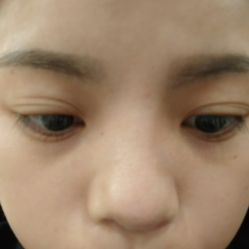 体验后-深圳春天阳光医院·轮廓抗衰中心