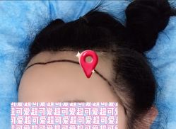 -大麦微针植发全国连锁