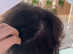 -碧莲盛·不剃发植发