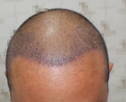 -大麦微针植发全国连锁