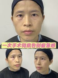 -广州健丽·去眼袋医疗美容机构