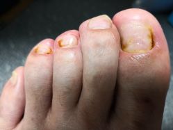 -派恩宜灰指甲鸡眼嵌甲手足癣