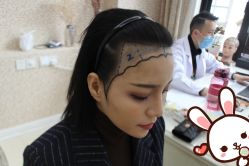 -大麦微针植发丨全国连锁