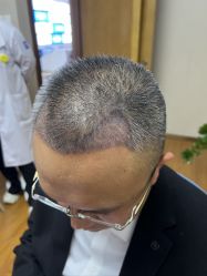 体验后-大麦微针植发全国连锁