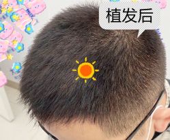 -大麦微针植发全国连锁