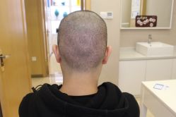 点击看大图 -大麦微针植发丨全国连锁