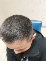 -大麦微针植发丨全国连锁