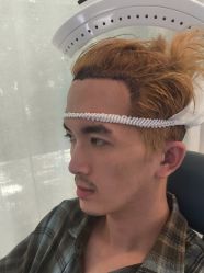 -大麦微针植发丨全国连锁