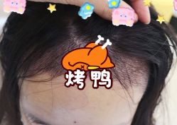 -大麦微针植发全国连锁