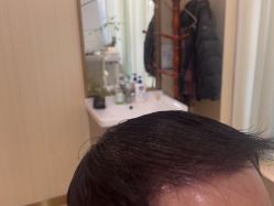 -碧莲盛·不剃发植发