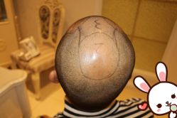 点击看大图 -大麦微针植发丨全国连锁