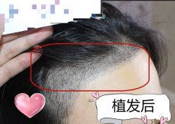 -大麦微针植发丨全国连锁