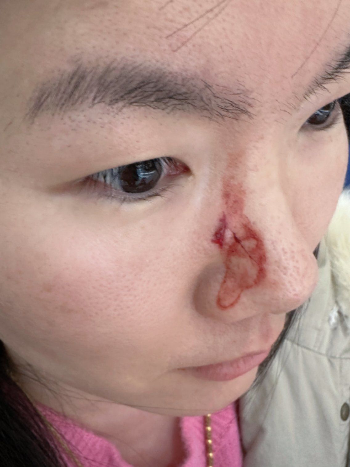 这家酒店有安全隐患,玻璃门把鼻子碰伤