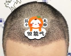 -大麦微针植发全国连锁