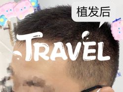 -大麦微针植发全国连锁