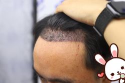 -大麦微针植发丨全国连锁