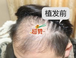 -大麦微针植发全国连锁