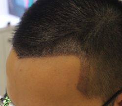 -大麦微针植发丨全国连锁