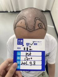 -大麦微针植发全国连锁