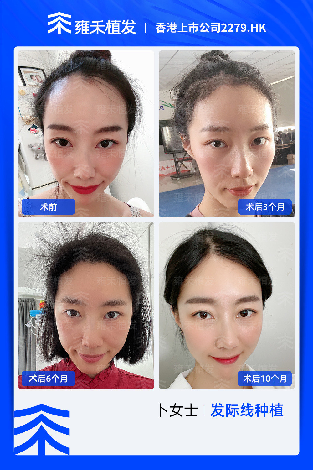 爱美的人植发(植发可以植美人尖吗)